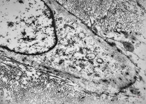 M,52y. | myofibroblastic tumor - pleura